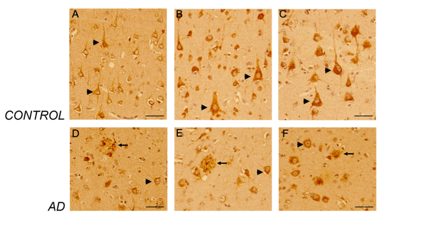Differential Expression of CD44 Variants in Normal and AD Brain ...